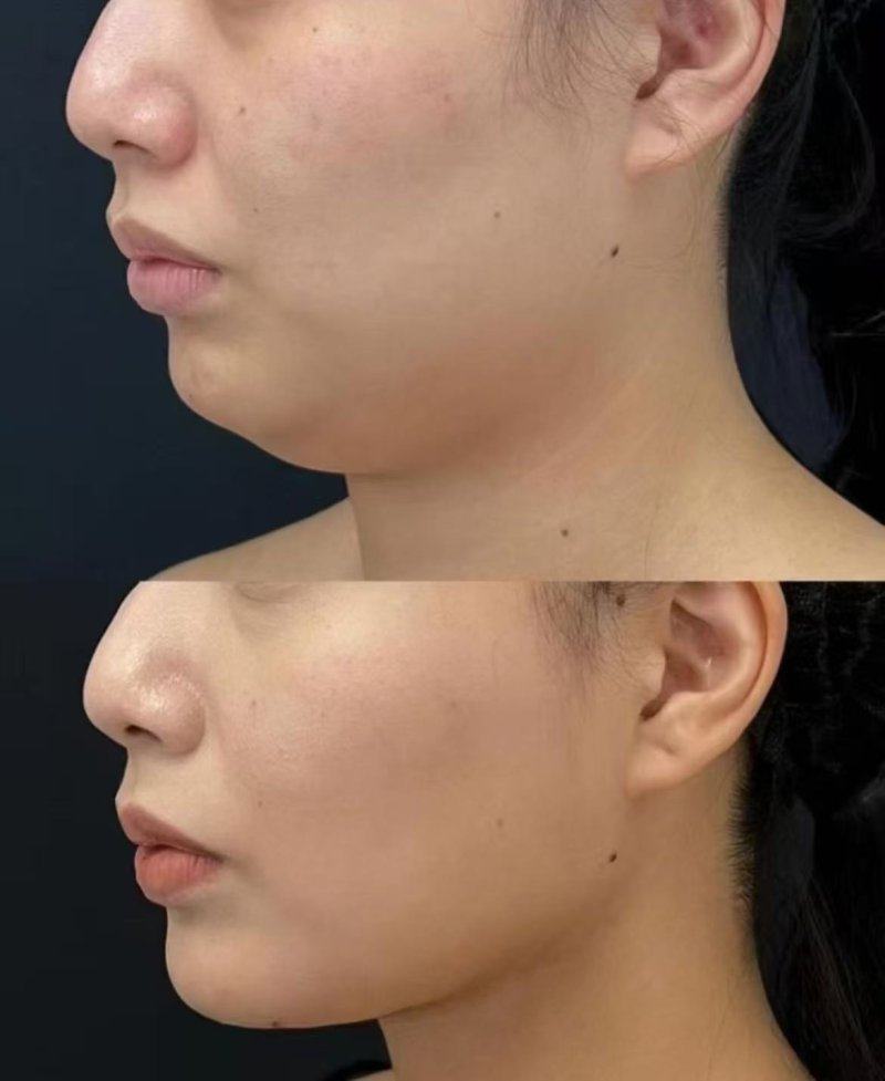 二、点痣留下疤痕增生怎么去除小妙招