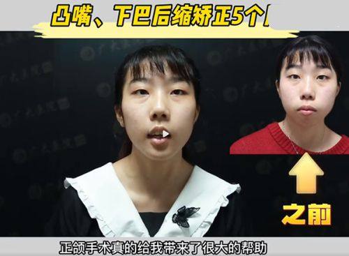 二、硅胶隆鼻容易感染吗？