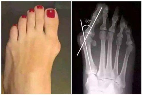 四、影响华美眼袋手术修复速度的关键因素