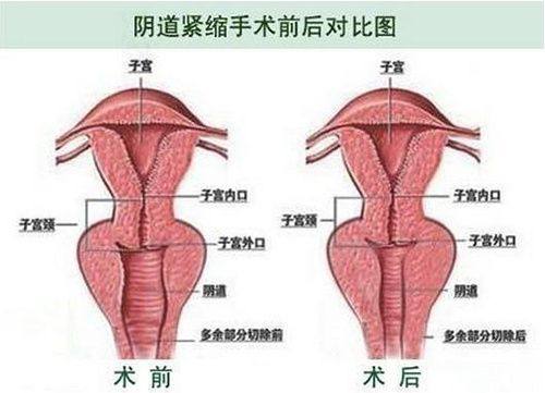 三、缝针疤痕凹陷能长平吗