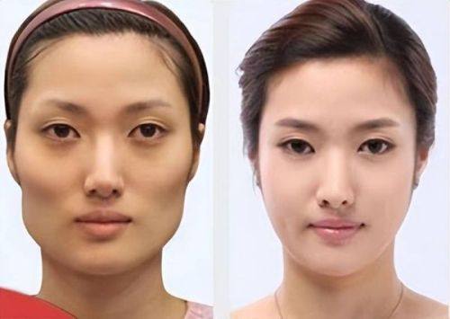 二、如何让缝针后凹陷疤痕快速修复