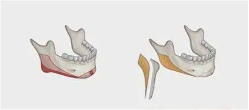 四、双眼皮手术前需要准备多久