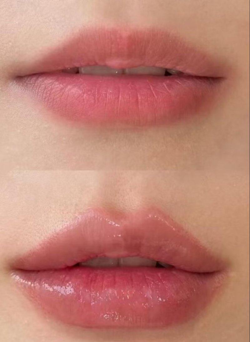 三、哪些因素会影响双眼皮手术的修复时长