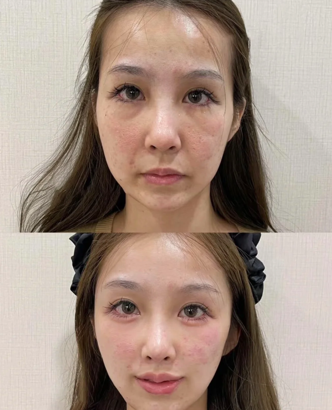 三、吸脂可能引发的皮肤与形态类后遗症