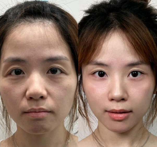 四、硅胶隆鼻会发炎吗？发炎离感染有多远？