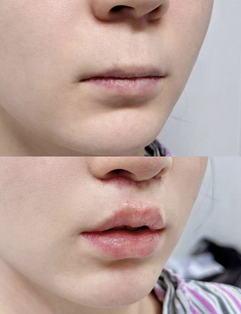 二、一般双眼皮手术要多久修复