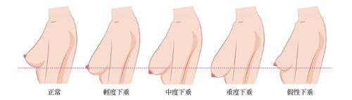 五、日常习惯加持,巩固去眼袋成效