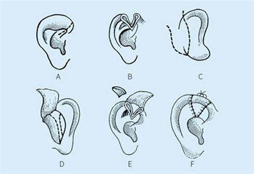 三、瘦脸针多久见成效