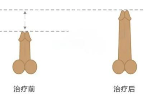 二、激光后增生疤痕多久才能修复