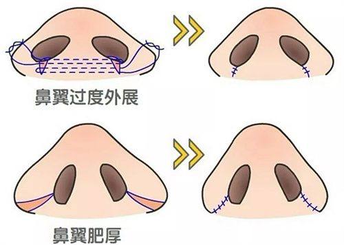 四、特殊疤痕（烧烫伤）变深的应对要点