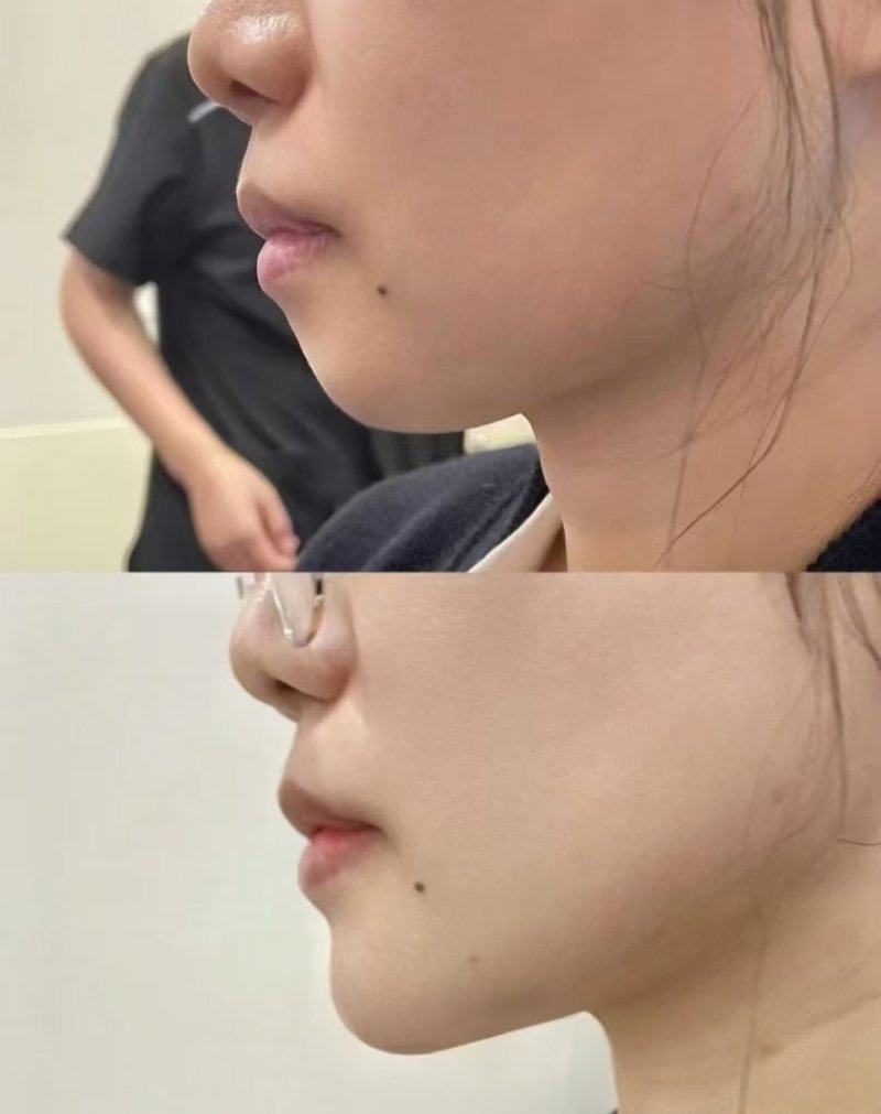 三、激光后留下的增生疤痕能自己淡化吗?