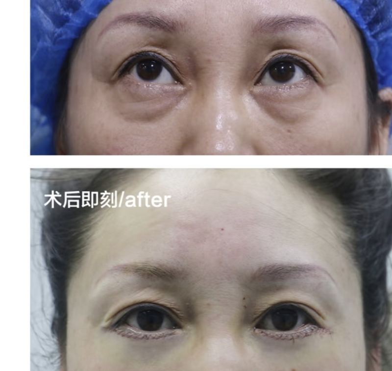 二、瘦脸针脸凹陷了还能修复以前吗