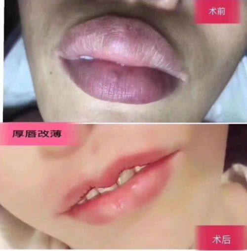 四、如何降低药水点痣的留疤概率