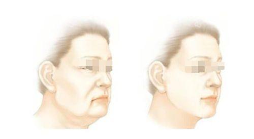 三、点痣膏腐蚀的皮肤会留疤吗