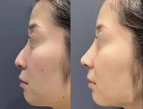 如何科学护理加速红印消退