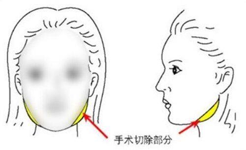 五、疤痕体质人群的眉形改善替代方案
