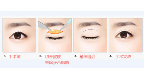 结痂掉了有红印会留疤吗