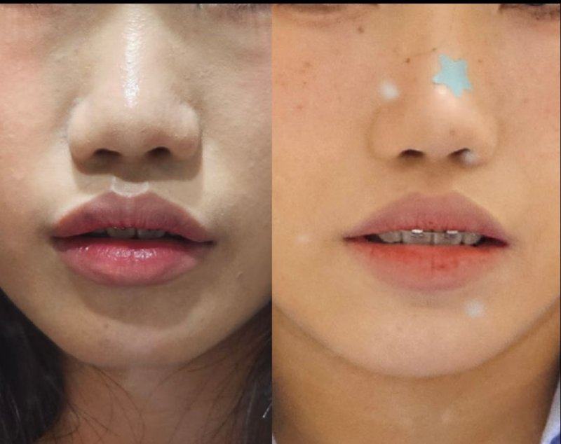 二、常见药水点痣的适用范围与风险