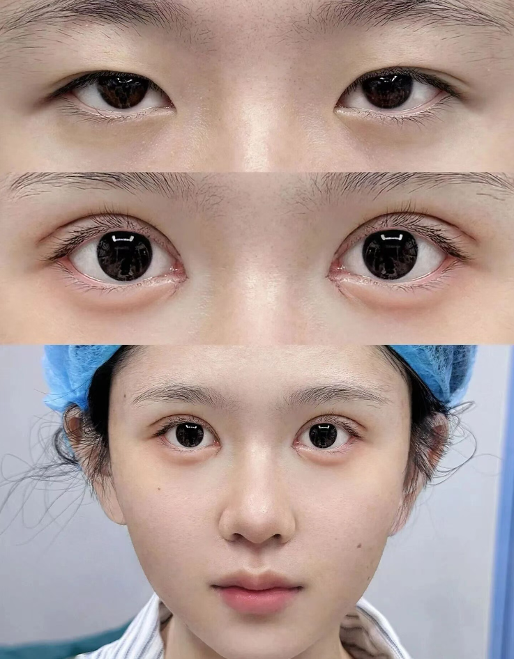 三、纹眉术后的核心护理禁忌