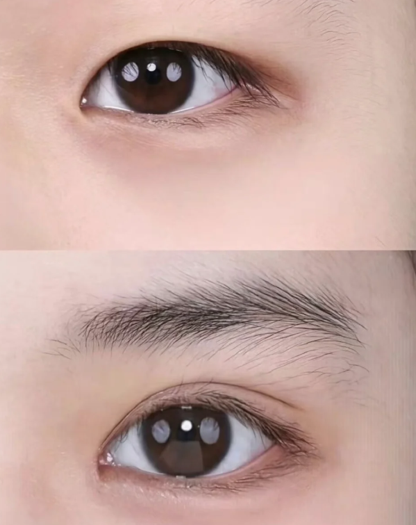 三、主流手术祛疤方式