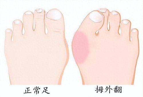 三、小孩睡醒变双眼皮长大会变么