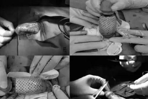 三、轻中度疤痕（3-6月）：医美干预改善外观