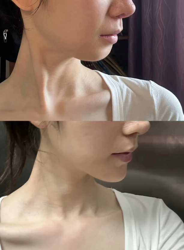 三、不同类型眼袋的适配方案