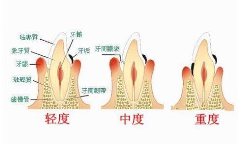 四、一觉睡醒单眼皮变成双眼皮还会修复吗？