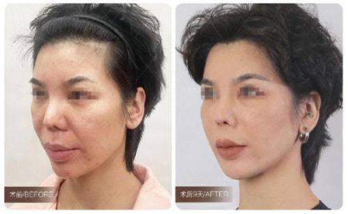 五、胸前疤痕疙瘩治疗后的注意事项