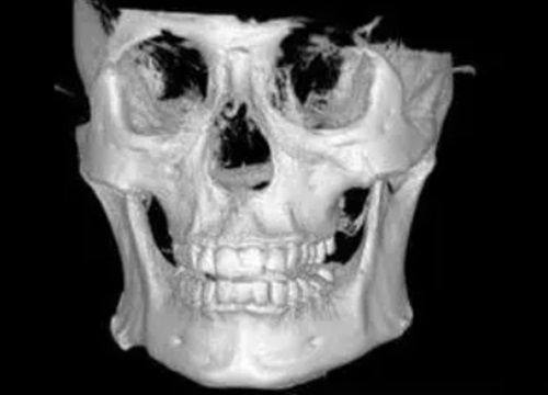 五、潜在的长期风险：假体破裂与皮肤异常