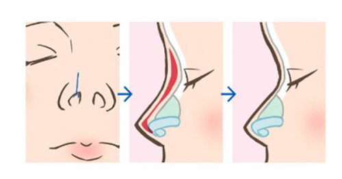 三、影响外观的核心问题：假体移位与形态异常