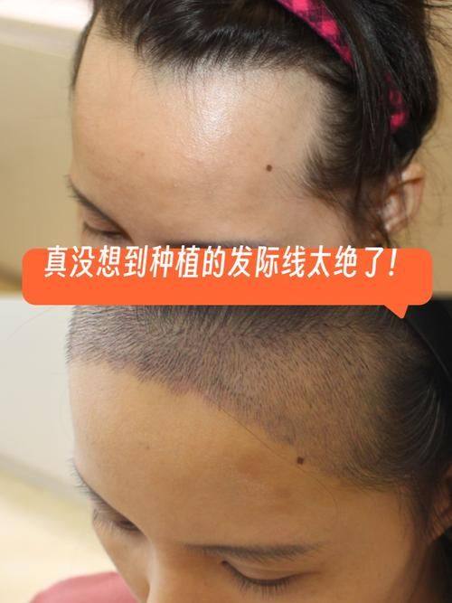 北京中德毛发移植整形医院有限公司擅长项目