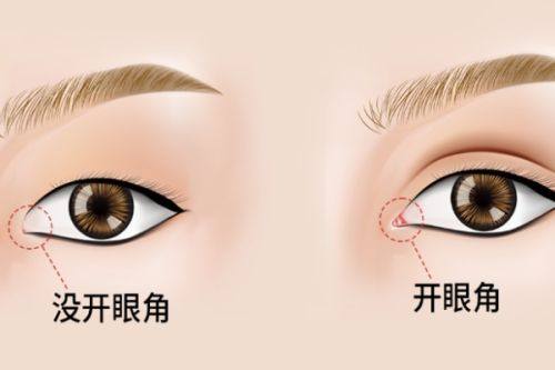 结尾：辨清成因对症改善，告别多层眼皮困扰