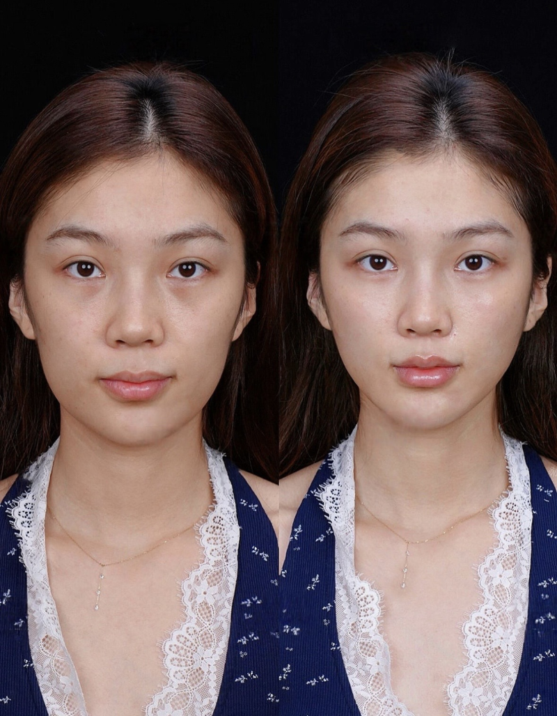 五、全切双眼皮修复期的核心护理要点