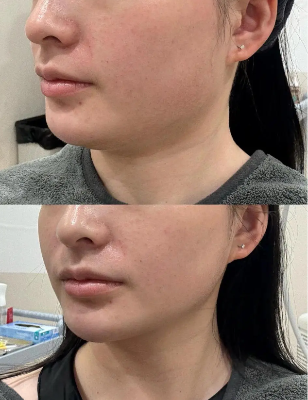 五、多层双眼皮怎么做手术