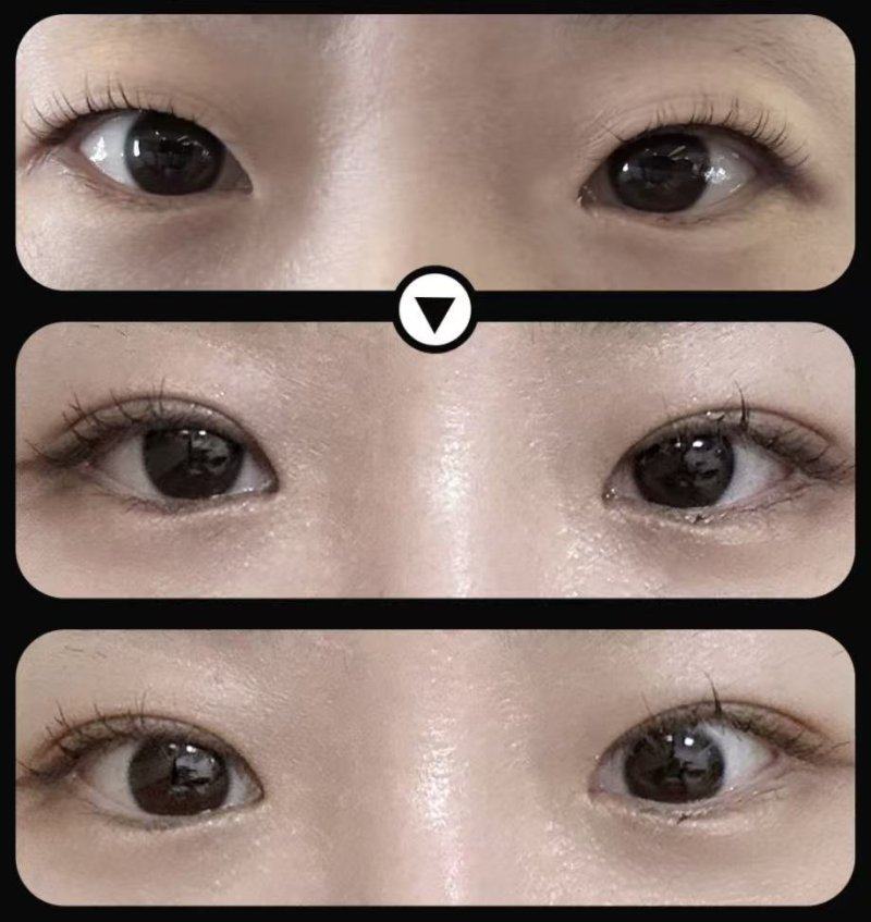 四、如何抑制凹陷疤痕的生长与加重