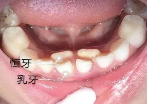 四、烫伤疤痕的肤色修复规律