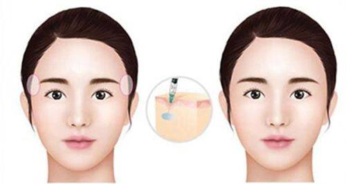 四、三角眼双眼皮设计的细节优化要点