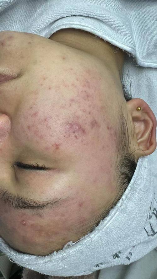 新疆维吾尔医医院皮肤美容科擅长项目