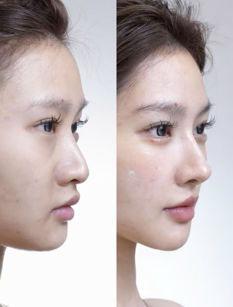 三、割双眼皮吃甜面酱有影响吗