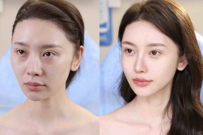 三、不同类型眼袋的护理成效差异