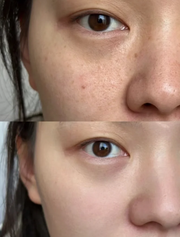 四、真实用户反馈，印证眼霜对真性眼袋的无效性