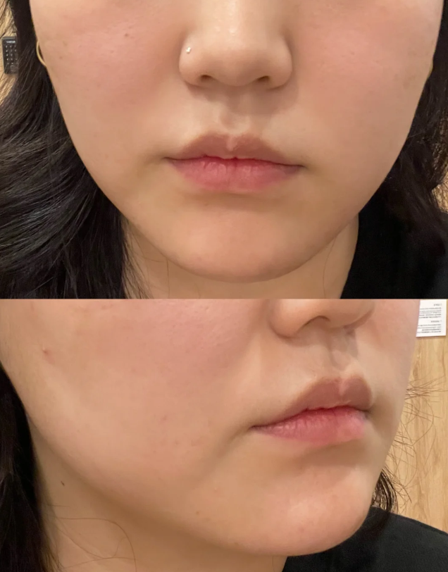 三、疱疹后红色疤痕多久变回肉色？