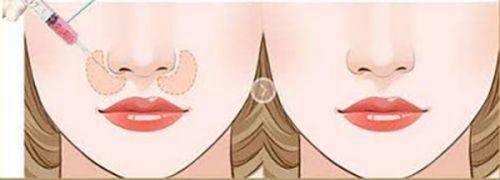 二、术后半年内疤痕修复的黄金指南