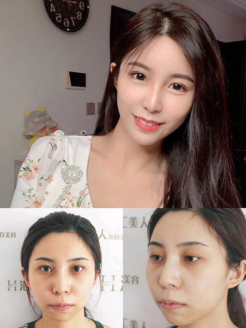 精细适配不同眼袋的改善方案