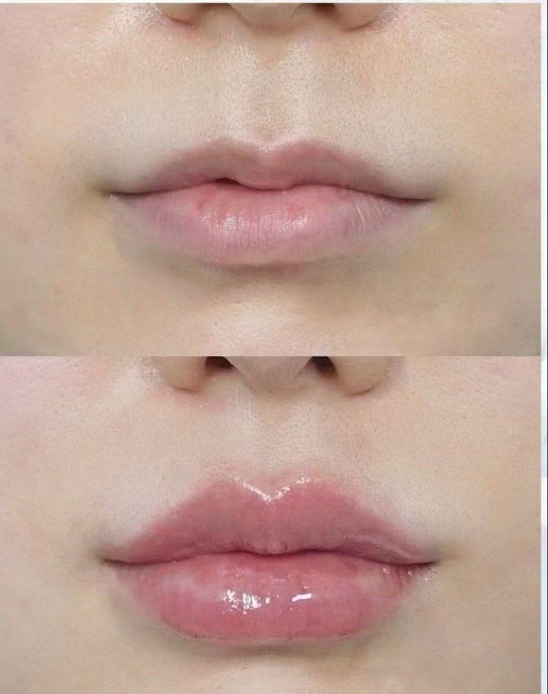 五、46岁割双眼皮的术后护理注意事项