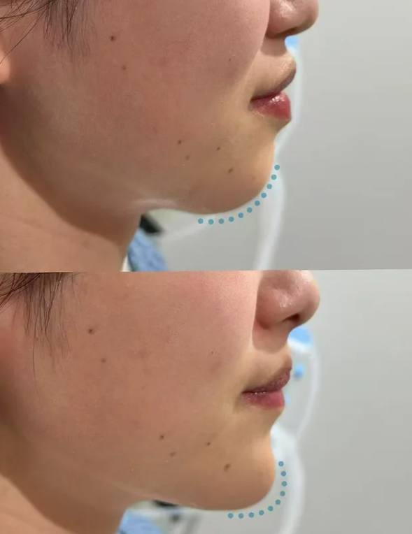 怎么样去除眼袋更有效