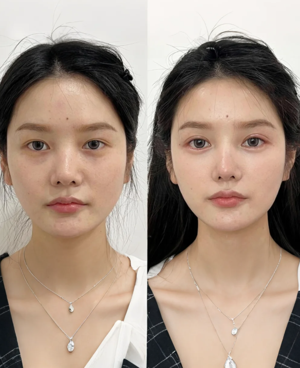 一、传统假体隆胸的核心细节