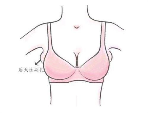 四、mesh+人工真皮组合垫：复合优化的双材料方案