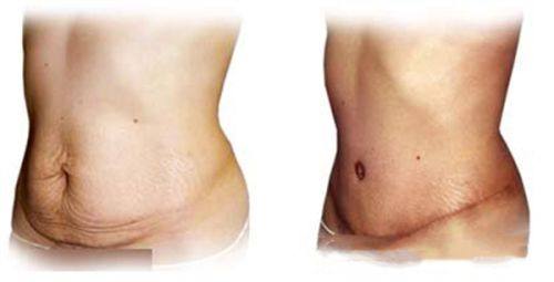 三、如何保护腹部抽脂的成效与规避风险？